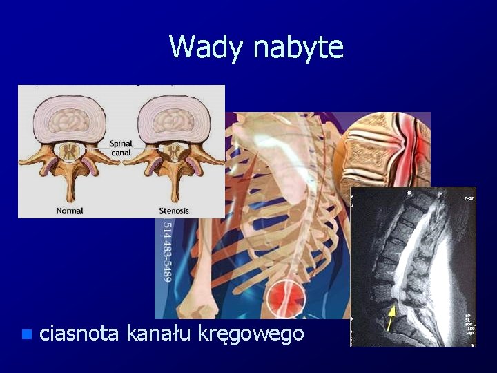 Wady nabyte n ciasnota kanału kręgowego 