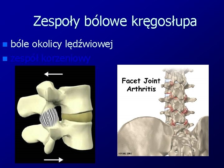 Zespoły bólowe kręgosłupa bóle okolicy lędźwiowej n zespół korzeniowy n 