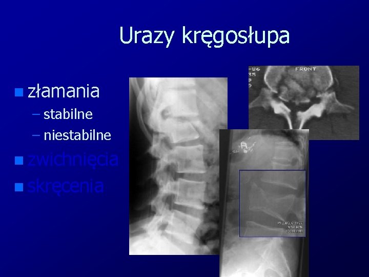 Urazy kręgosłupa n złamania – stabilne – niestabilne n zwichnięcia n skręcenia 