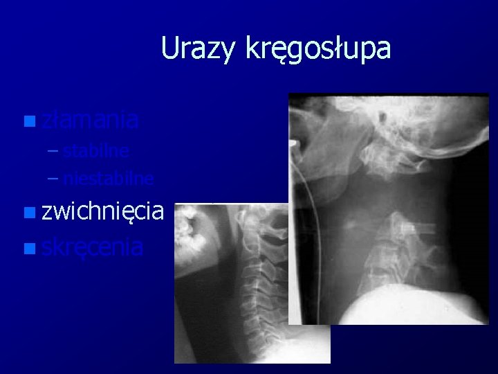 Urazy kręgosłupa n złamania – stabilne – niestabilne n zwichnięcia n skręcenia 