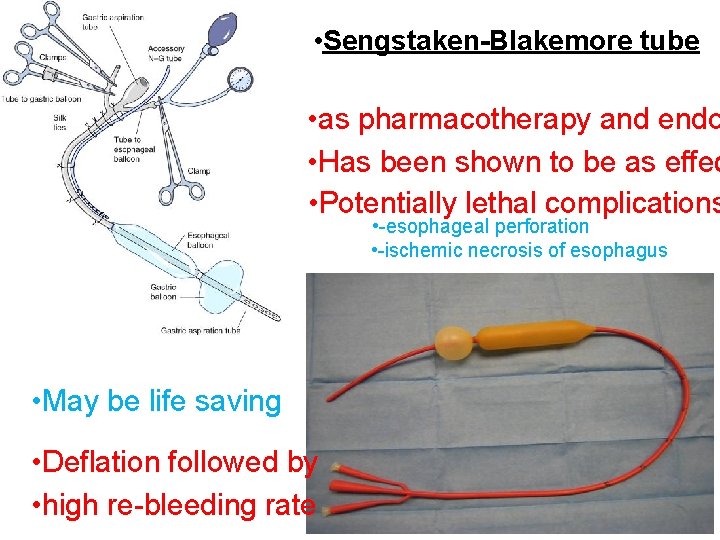  • Sengstaken-Blakemore tube • as pharmacotherapy and endo • Has been shown to