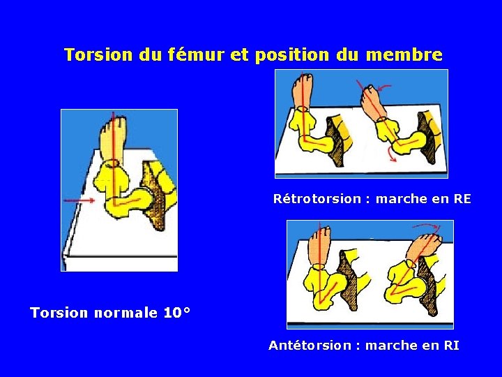 Torsion du fémur et position du membre Rétrotorsion : marche en RE Torsion normale
