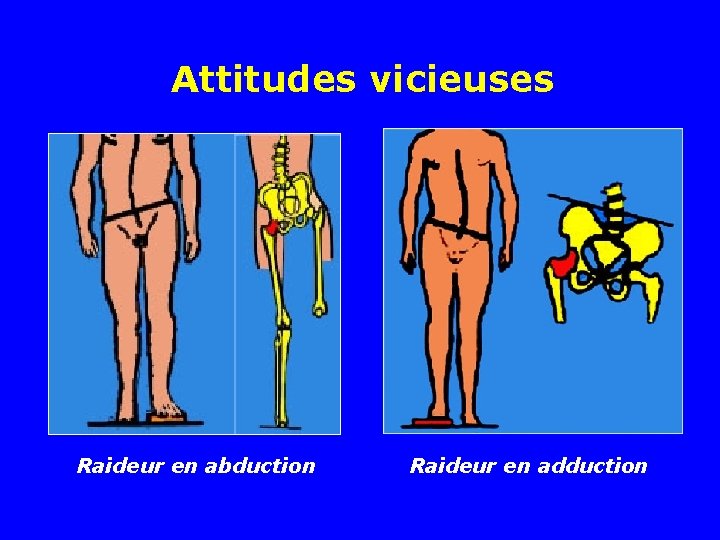 Attitudes vicieuses Raideur en abduction Raideur en adduction 