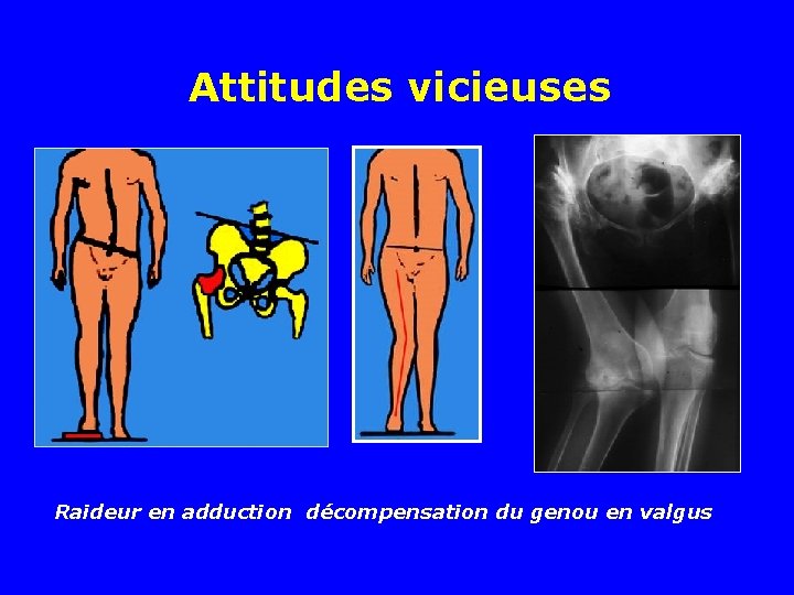 Attitudes vicieuses Raideur en adduction décompensation du genou en valgus Attitudes vicieuses Raideur en adduction décompensation du genou en valgus