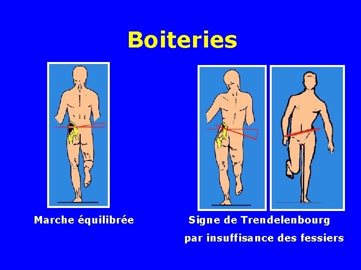 Boiteries Marche équilibrée Signe de Trendelenbourg par insuffisance des fessiers 