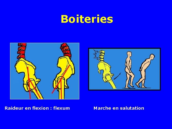 Boiteries Raideur en flexion : flexum Marche en salutation 