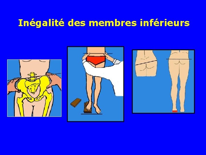 Inégalité des membres inférieurs 