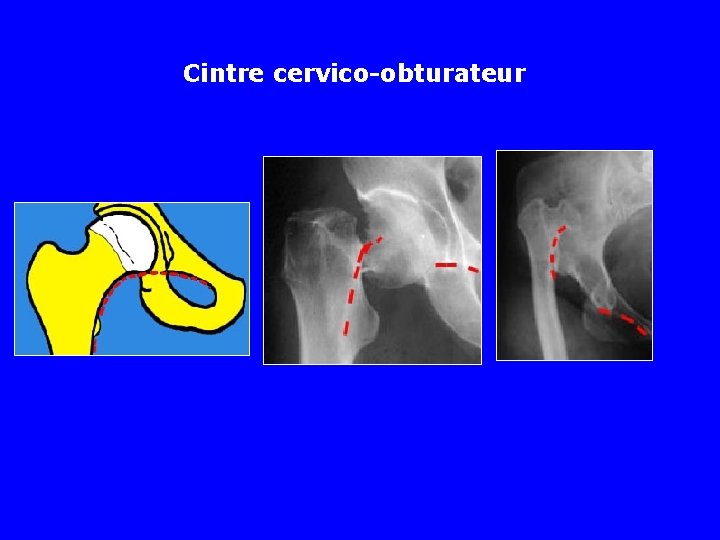 Cintre cervico-obturateur 