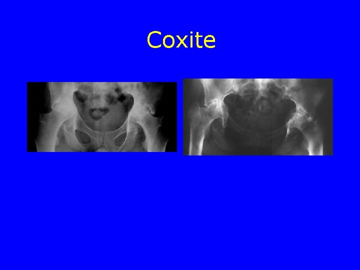 Coxite 