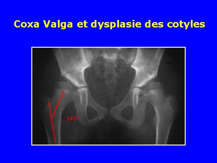 Coxa Valga et dysplasie des cotyles 145° 