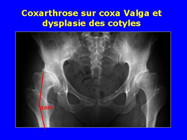 Coxarthrose sur coxa Valga et dysplasie des cotyles 160° 