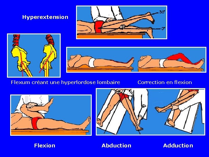 Hyperextension Flexum créant une hyperlordose lombaire Flexion Abduction Correction en flexion Adduction Hyperextension Flexum créant une hyperlordose lombaire Flexion Abduction Correction en flexion Adduction