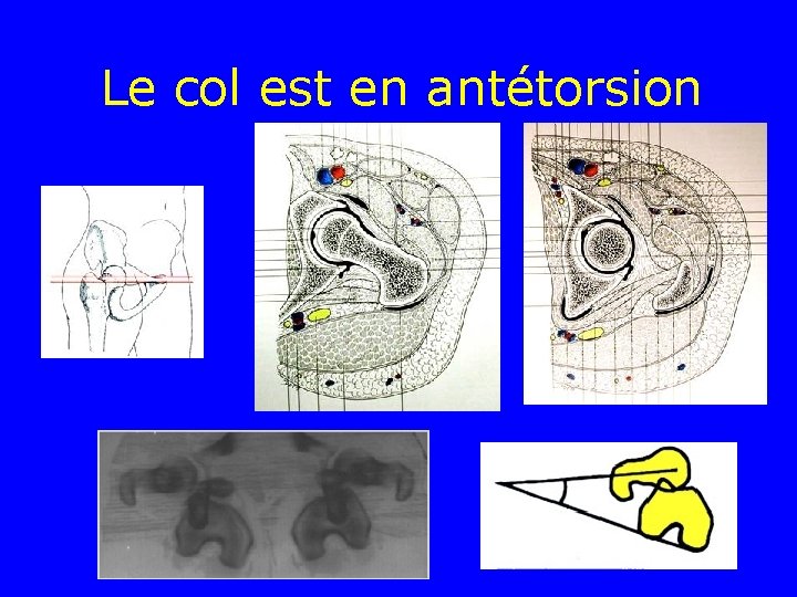 Le col est en antétorsion 