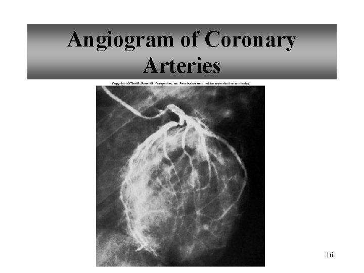 Angiogram of Coronary Arteries 16 