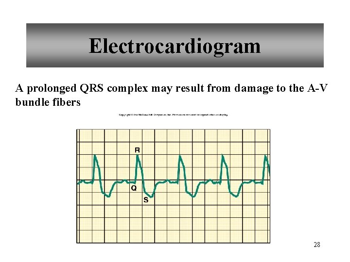 Electrocardiogram A prolonged QRS complex may result from damage to the A-V bundle fibers