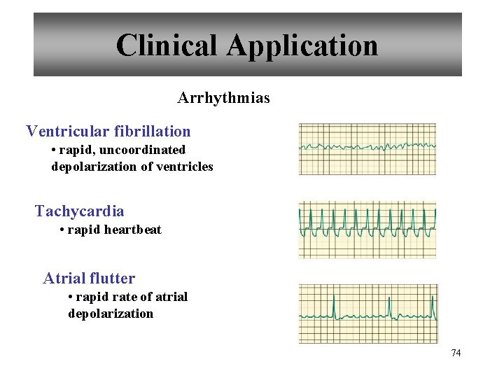 Clinical Application Arrhythmias Ventricular fibrillation • rapid, uncoordinated depolarization of ventricles Tachycardia • rapid