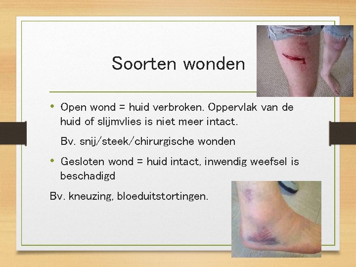 Soorten wonden • Open wond = huid verbroken. Oppervlak van de huid of slijmvlies