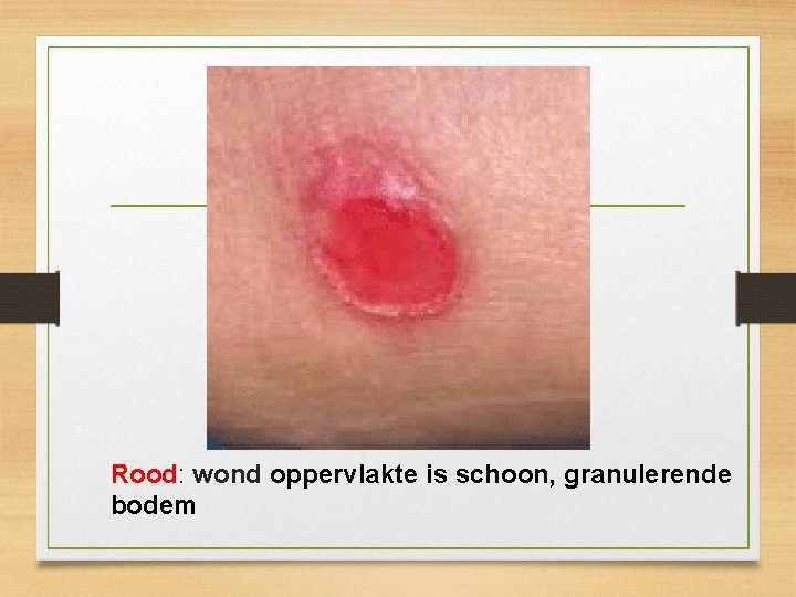 Rood: wond oppervlakte is schoon, granulerende bodem 