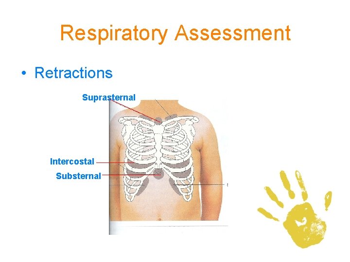 Respiratory Assessment • Retractions Suprasternal Intercostal Substernal 