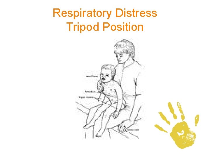 Respiratory Distress Tripod Position 