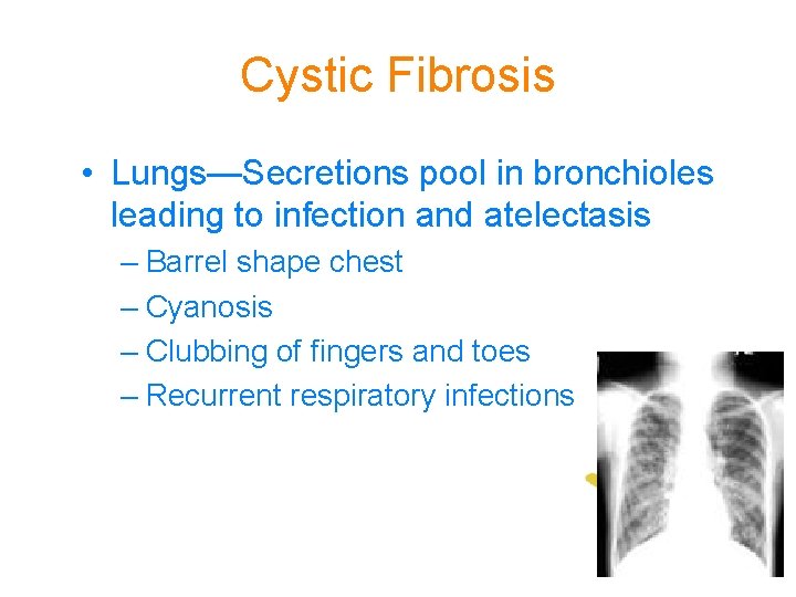 Cystic Fibrosis • Lungs—Secretions pool in bronchioles leading to infection and atelectasis – Barrel