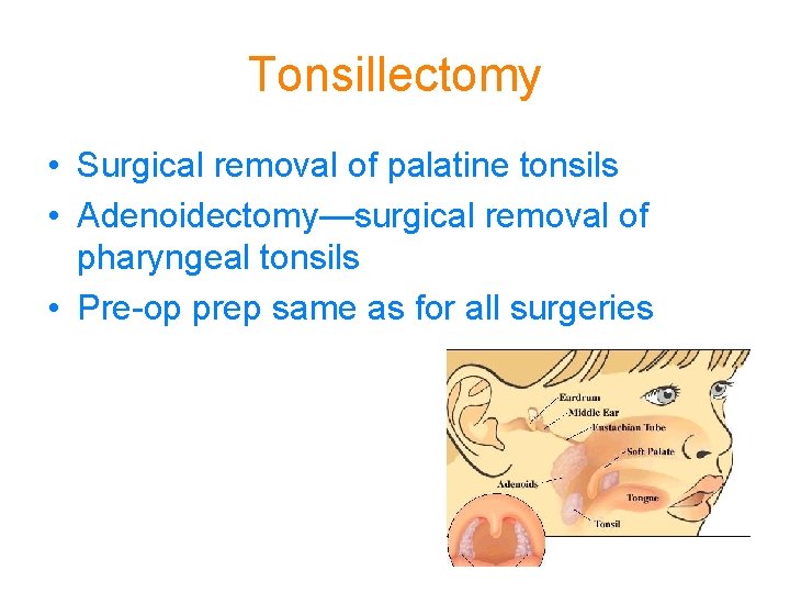Tonsillectomy • Surgical removal of palatine tonsils • Adenoidectomy—surgical removal of pharyngeal tonsils •