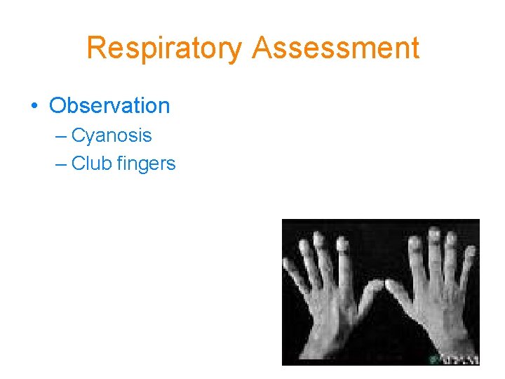 Respiratory Assessment • Observation – Cyanosis – Club fingers 