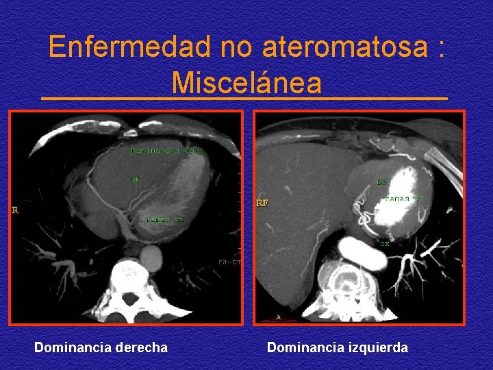 Enfermedad no ateromatosa : Miscelánea Dominancia derecha Dominancia izquierda 