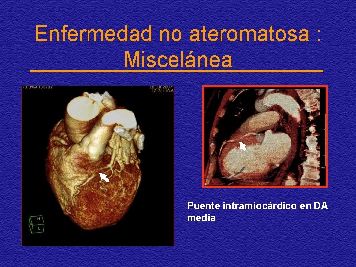 Enfermedad no ateromatosa : Miscelánea Puente intramiocárdico en DA media 