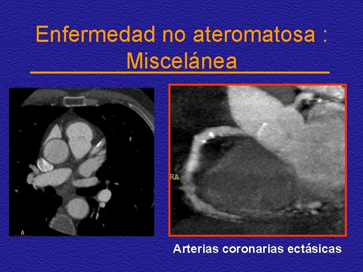 Enfermedad no ateromatosa : Miscelánea Arterias coronarias ectásicas 