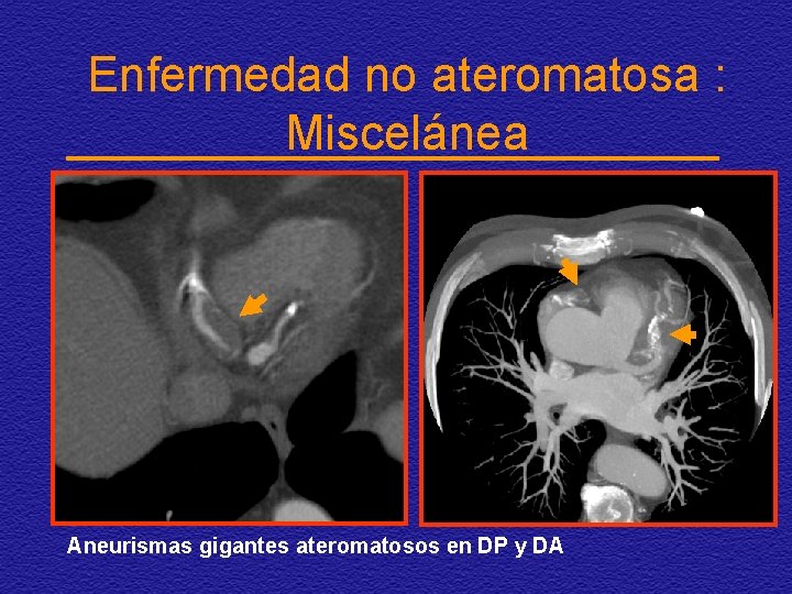 Enfermedad no ateromatosa : Miscelánea Aneurismas gigantes ateromatosos en DP y DA 