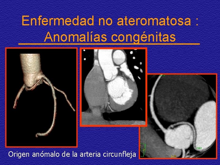 Enfermedad no ateromatosa : Anomalías congénitas Origen anómalo de la arteria circunfleja 