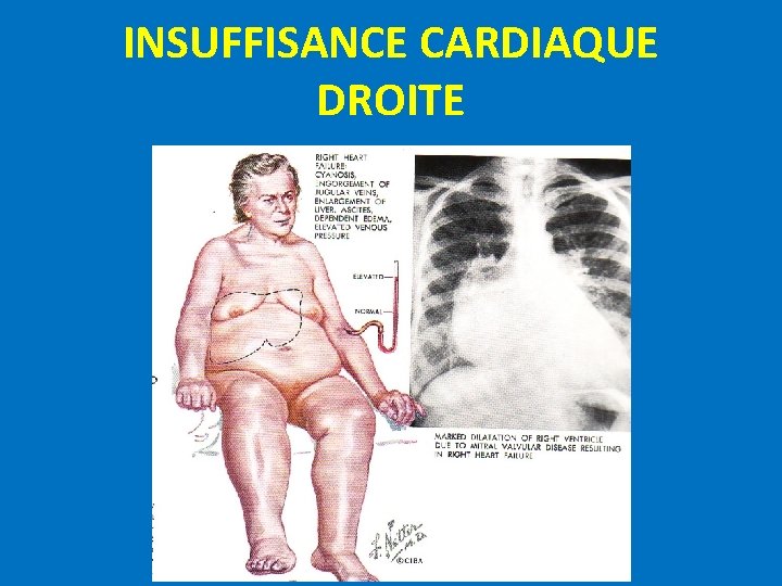 INSUFFISANCE CARDIAQUE DROITE 