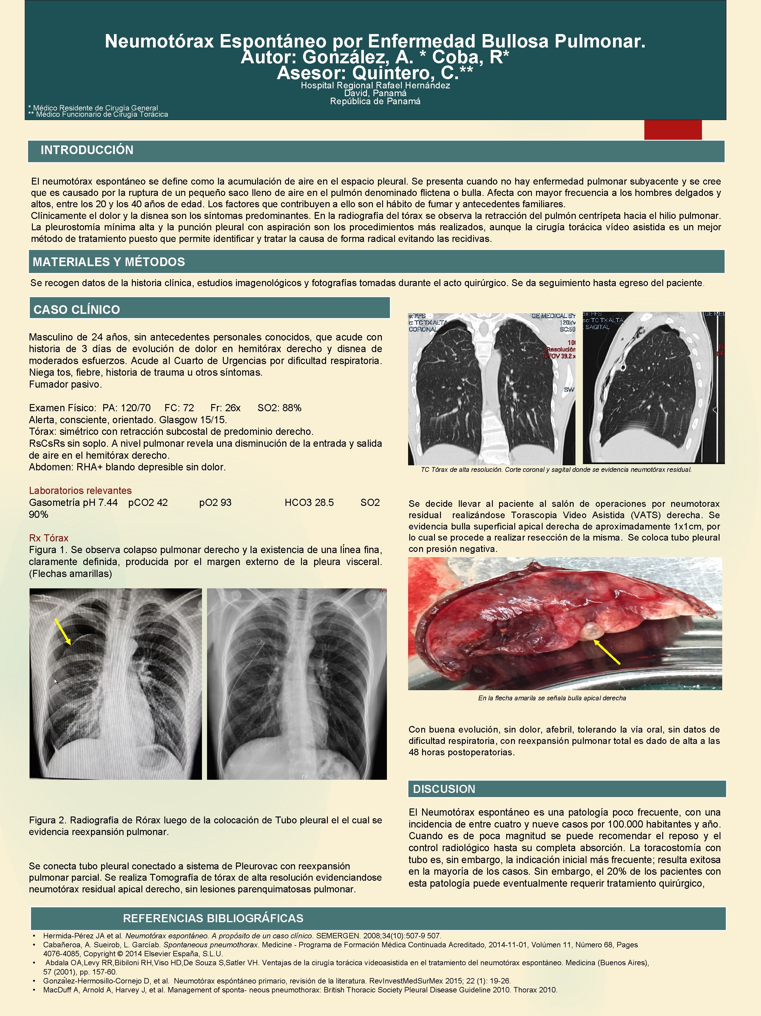 Neumotórax Espontáneo por Enfermedad Bullosa Pulmonar. Autor: González, A. * Coba, R* Asesor: Quintero,