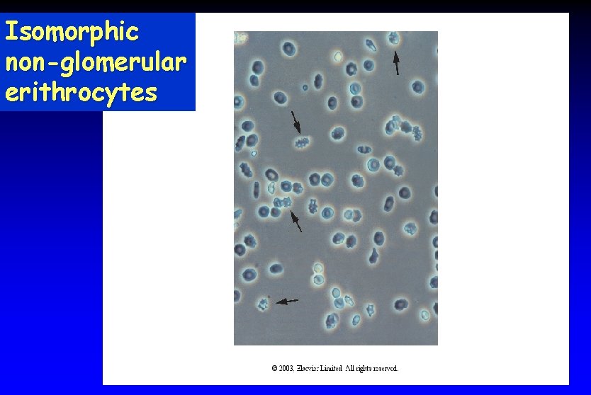 Isomorphic non-glomerular erithrocytes 