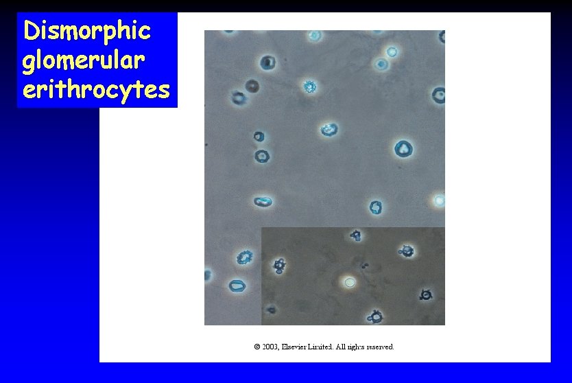 Dismorphic glomerular erithrocytes 