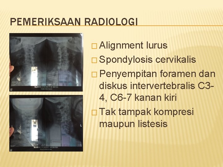 PEMERIKSAAN RADIOLOGI � Alignment lurus � Spondylosis cervikalis � Penyempitan foramen dan diskus intervertebralis