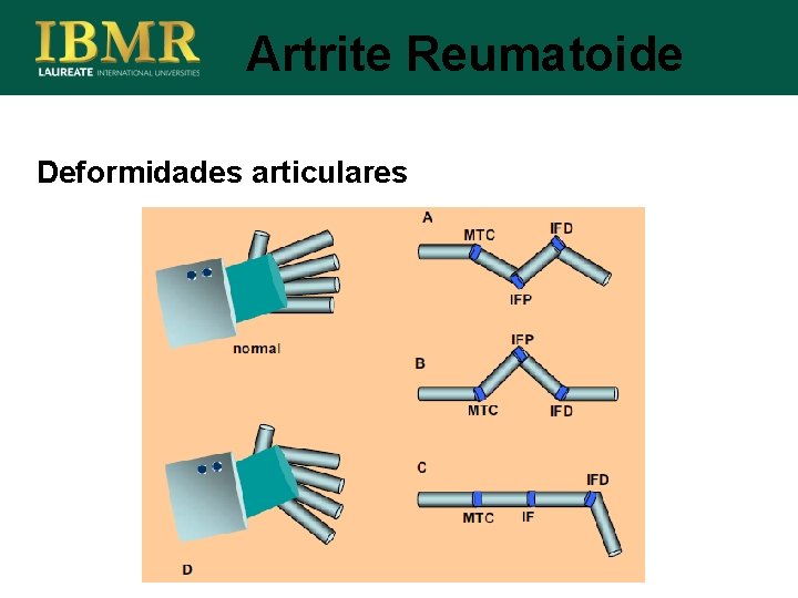 Artrite Reumatoide Deformidades articulares 