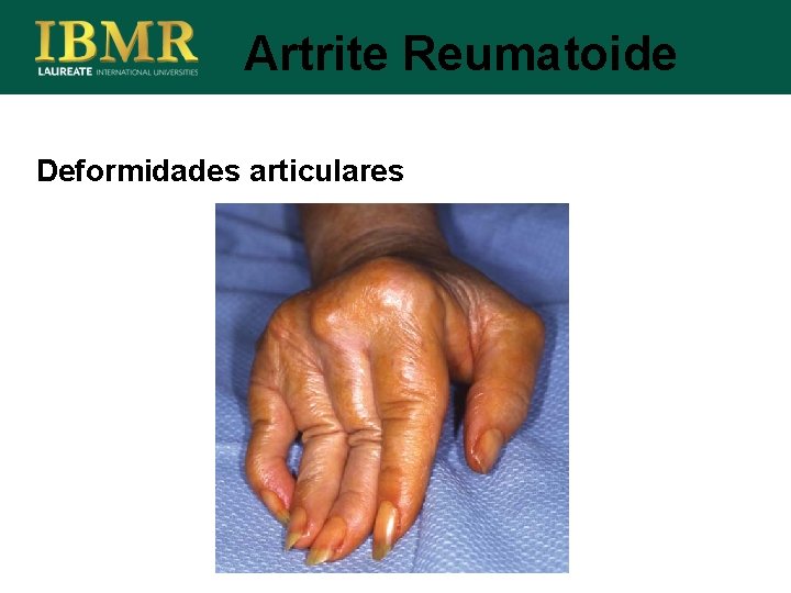 Artrite Reumatoide Deformidades articulares 