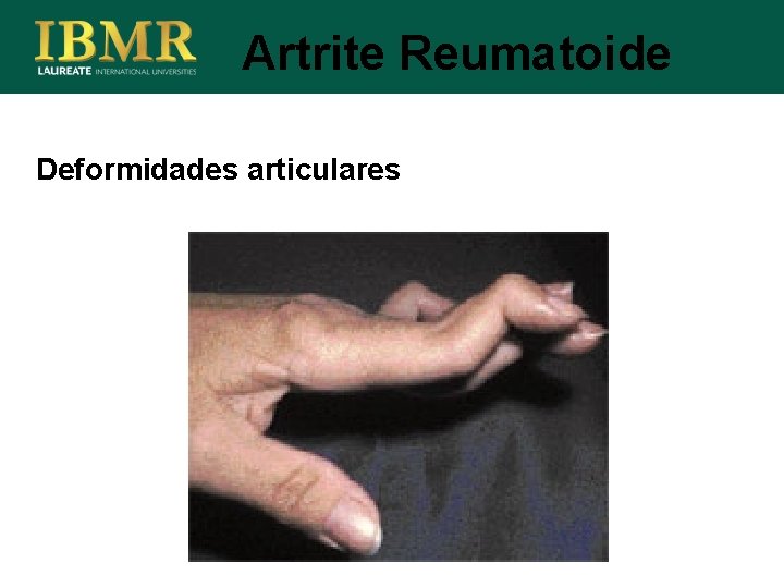 Artrite Reumatoide Deformidades articulares 