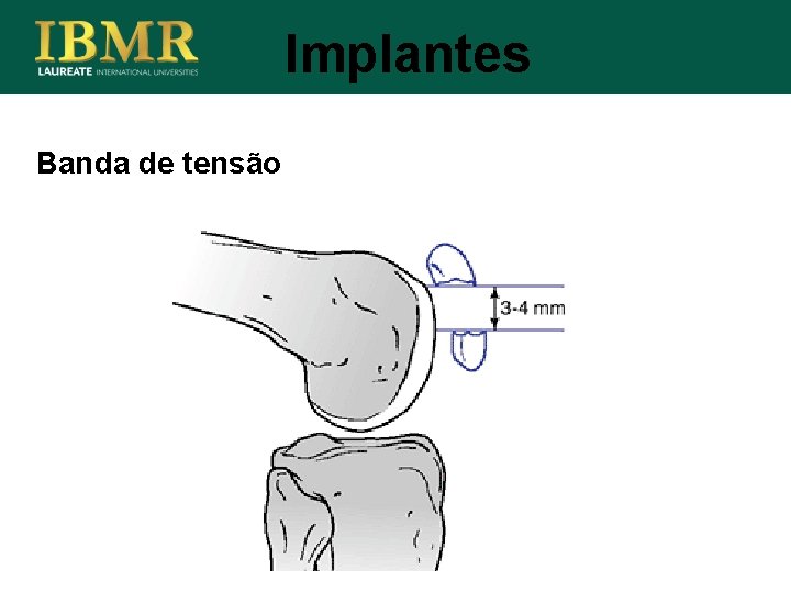 Implantes Banda de tensão 