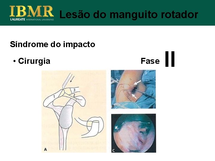 Lesão do manguito rotador Síndrome do impacto • Cirurgia Fase II 