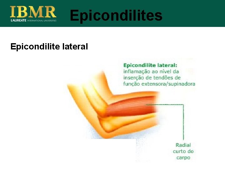 Epicondilites Epicondilite lateral 