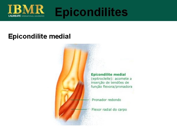 Epicondilites Epicondilite medial 