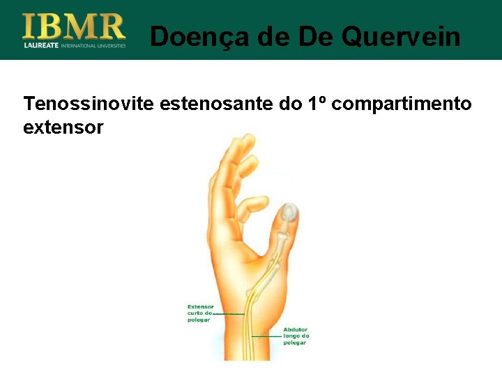 Doença de De Quervein Tenossinovite estenosante do 1º compartimento extensor 