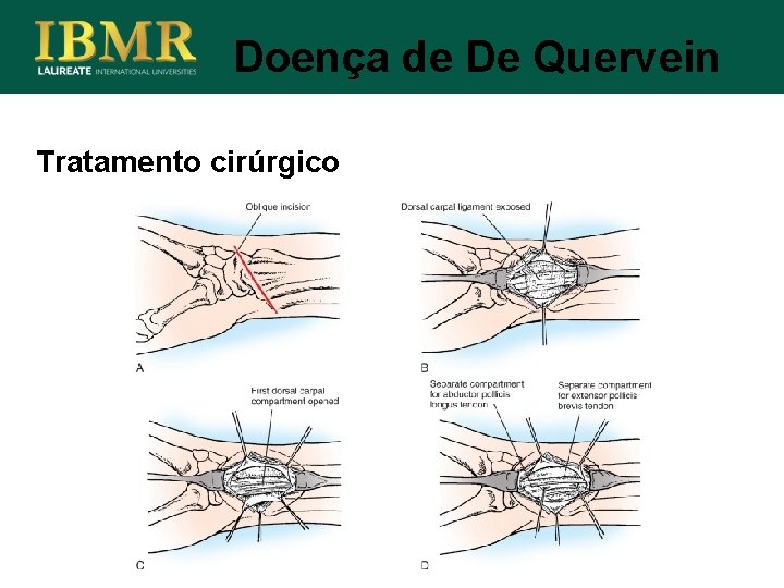 Doença de De Quervein Tratamento cirúrgico 