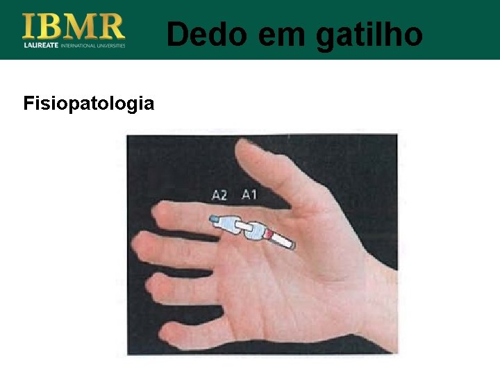 Dedo em gatilho Fisiopatologia 