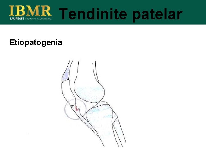 Tendinite patelar Etiopatogenia 