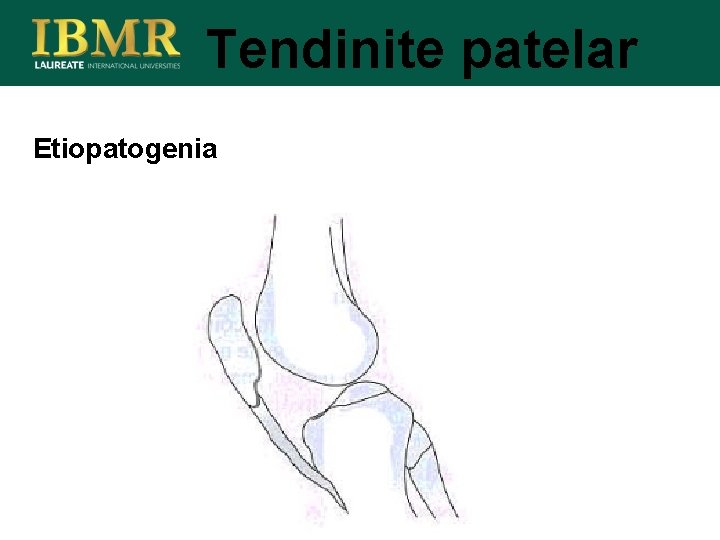 Tendinite patelar Etiopatogenia 