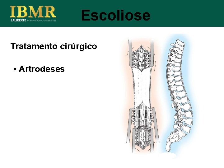 Escoliose Tratamento cirúrgico • Artrodeses 